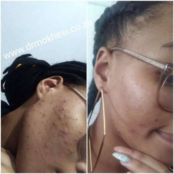 acne skin face